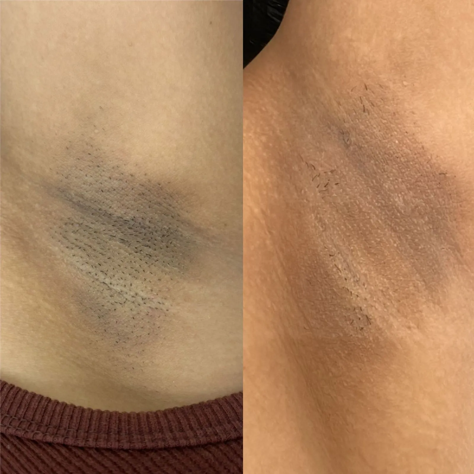 Resultado de Depilação a Laser - 24/04/2026
