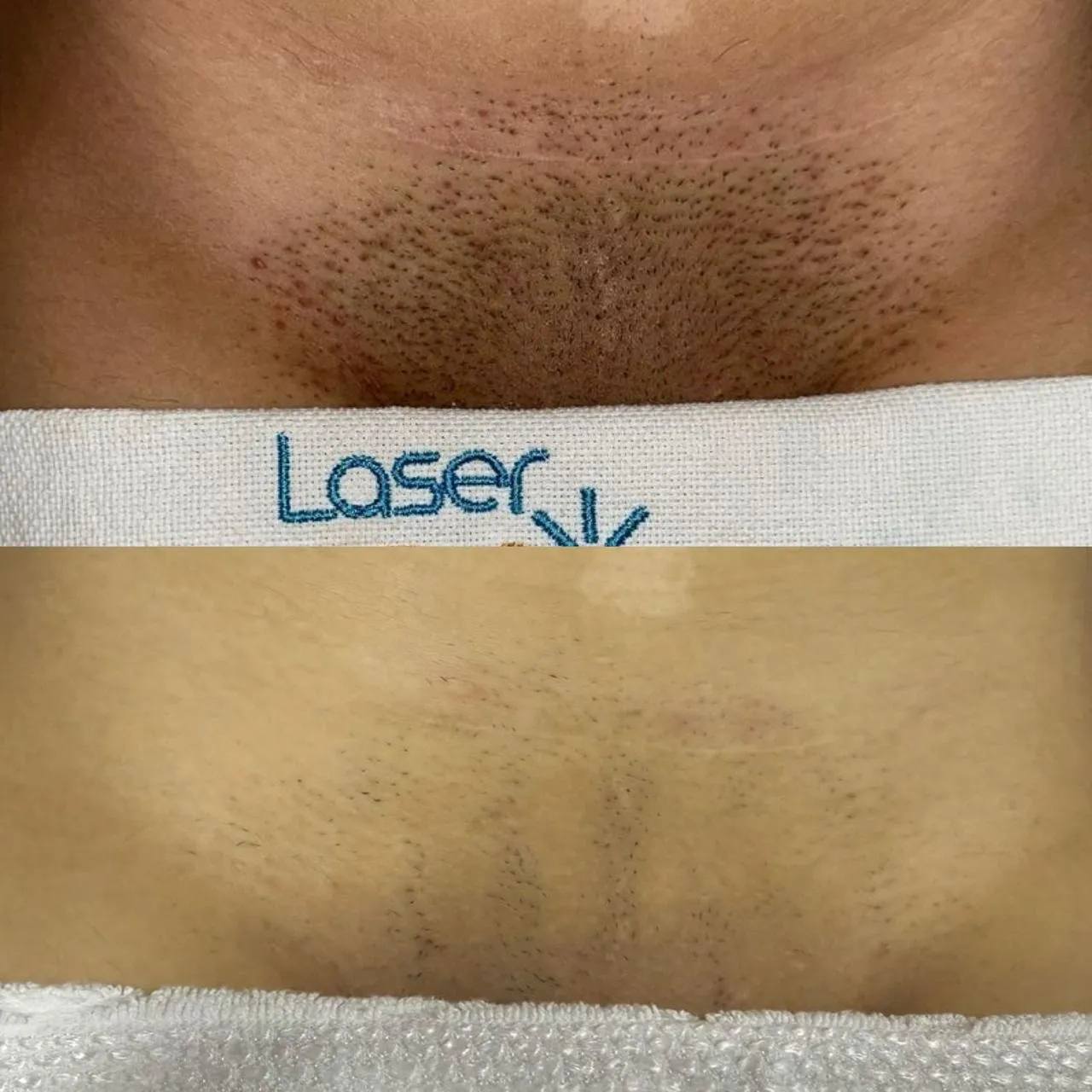 Resultado de Depilação a Laser - 24/04/2026