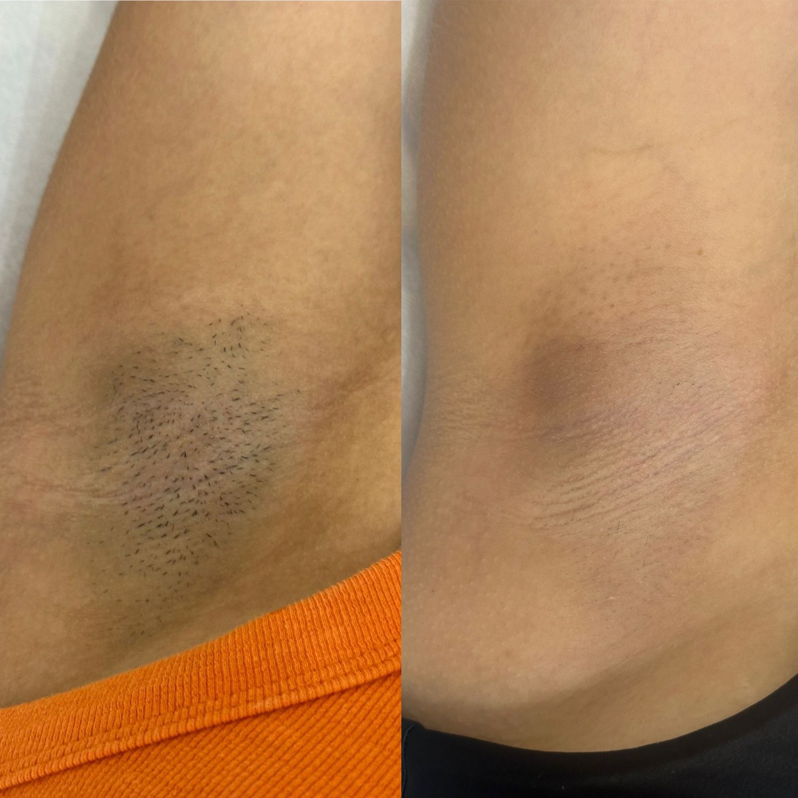 Resultado Real Depilação a Laser Axilas