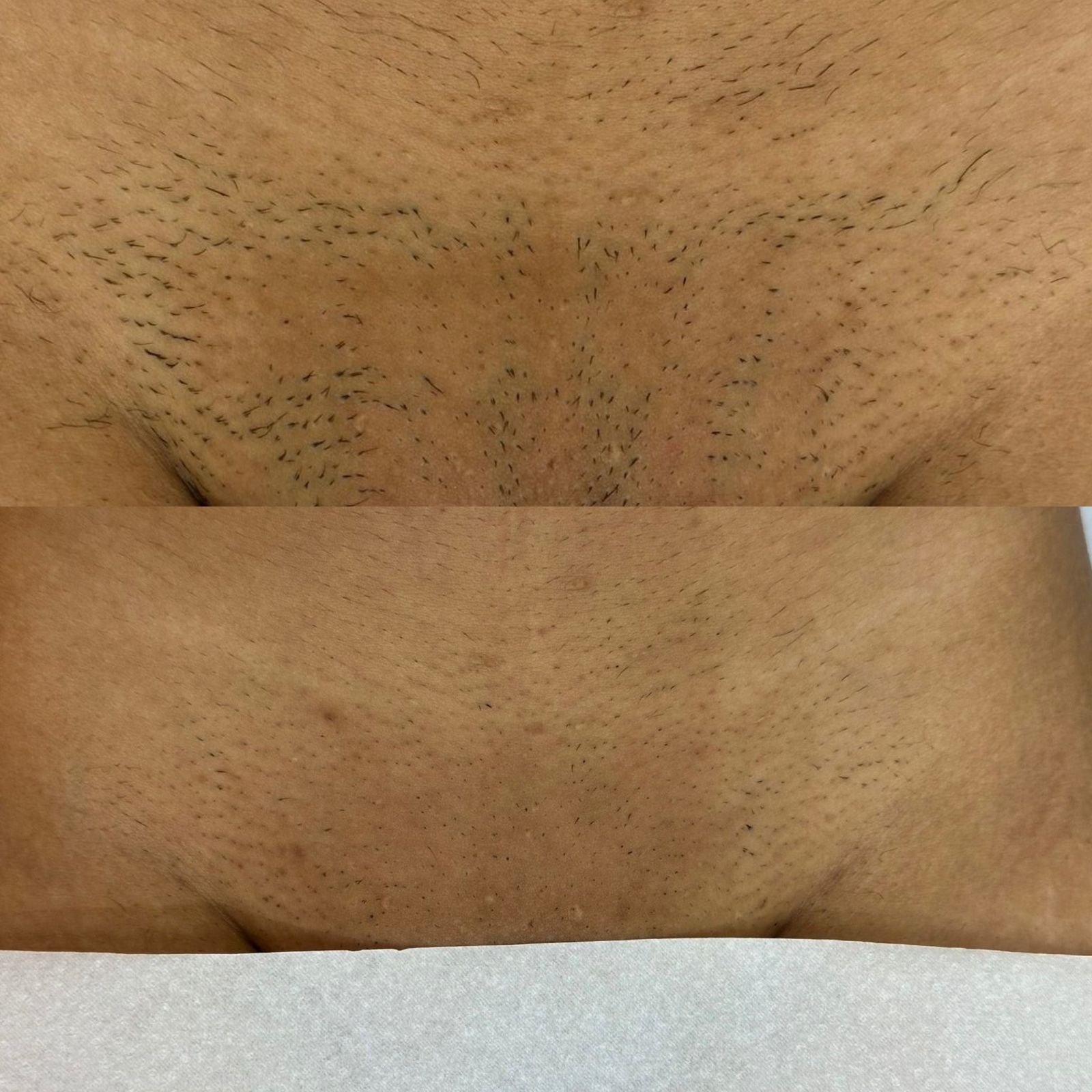 Resultado Real Depilação a Laser Virilha